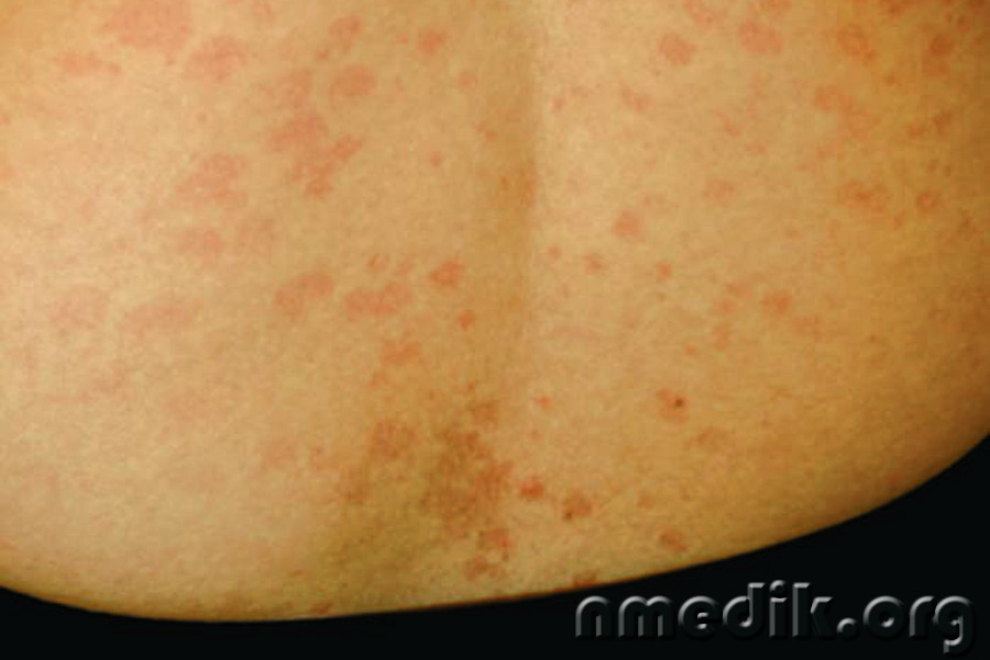 Грибковые заболевания кожи - на фото опоясывающий лишай