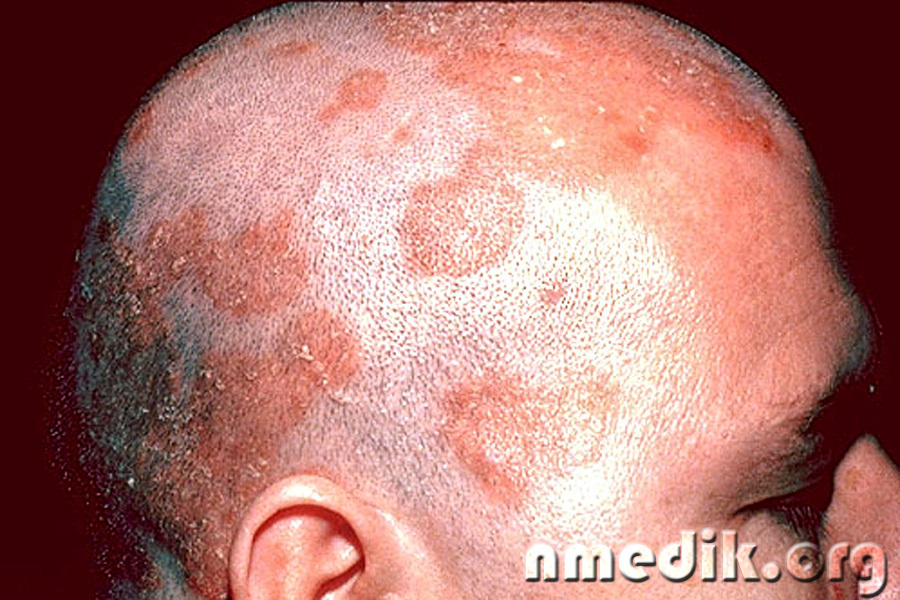 Себорея головы - симптомы и лечение