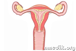 Воспаление женских половых органов - симптомы и лечение