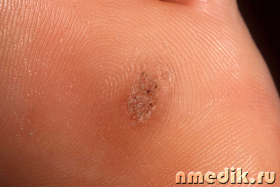 Лечение чесноком кожных болезней
