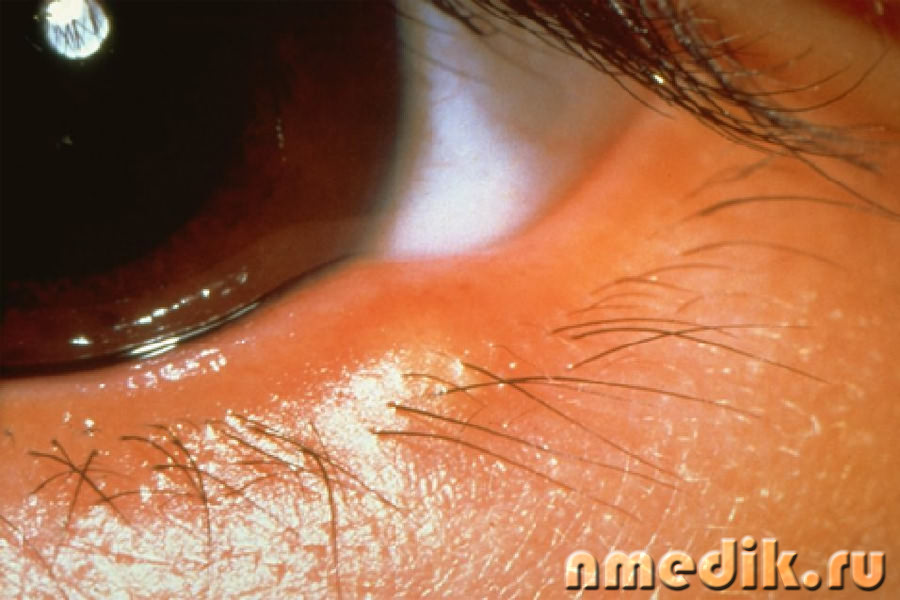 Ячмень на глазу - причины, симптомы и лечение