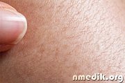 Мумие при заболеваниях кожи