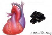 Мумие при заболеваниях сердечно-сосудистой системы