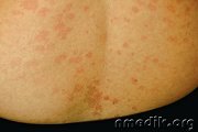 Грибковые заболевания кожи - симптомы и лечение