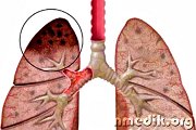 Туберкулез легких - симптомы и лечение
